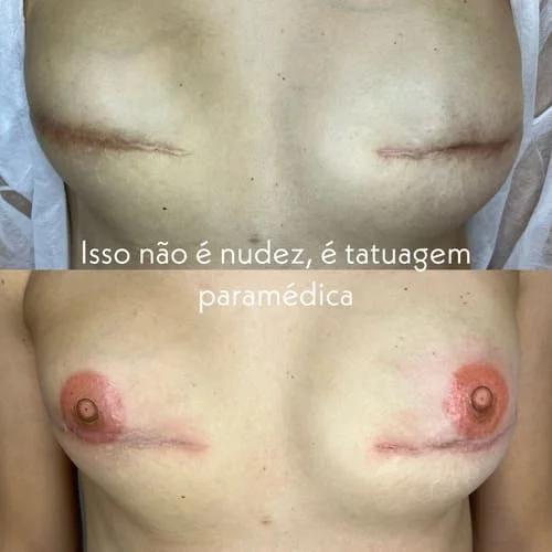 Reconstrução areolar (1)