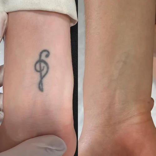 Remoção de tatuagem